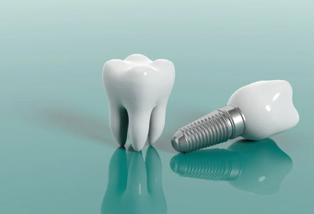 The Science and Art of Dental Implants