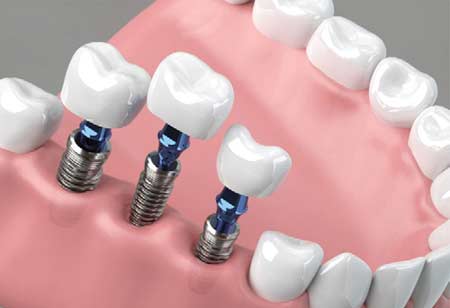 The Global Investment Boom in the U.S Dental Implants Market