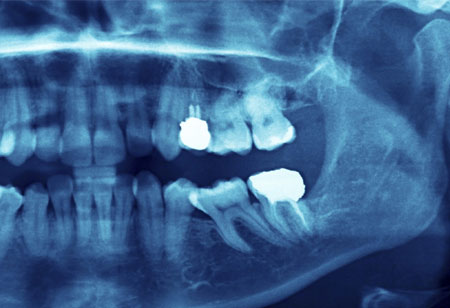 Medical Imaging becomes more Accurate and Easier with 3D X-Ray Techniques