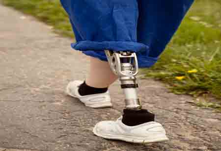 The Importance of Personalized Orthotics and Prosthetics in Improving Quality of Life