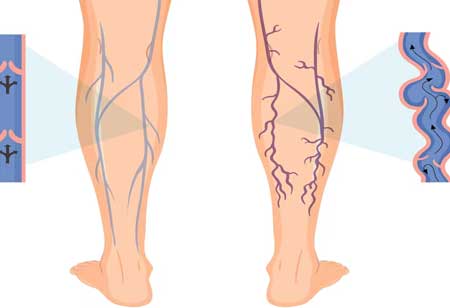 How to Prevent the Most Common Vascular Diseases